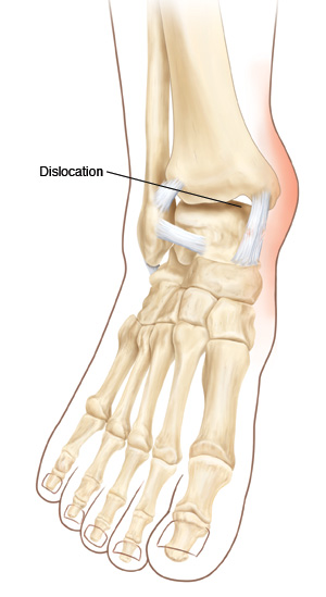 Front view of ankle and foot bones showing ankle dislocation.